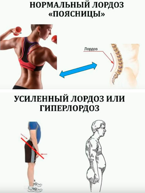 Коррекция гиперлордоза поясничного отдела позвоночника Коррекция гиперлордоза поясничного отдела позвоночника