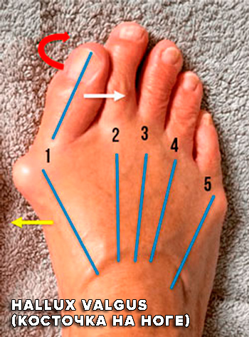 Hallux Valgus косточка на ноге лечение Hallux Valgus косточка на ноге лечение