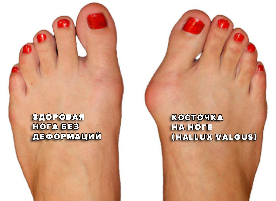 Как выглядит косточка на ноге Hallux Valgus Как выглядит косточка на ноге Hallux Valgus