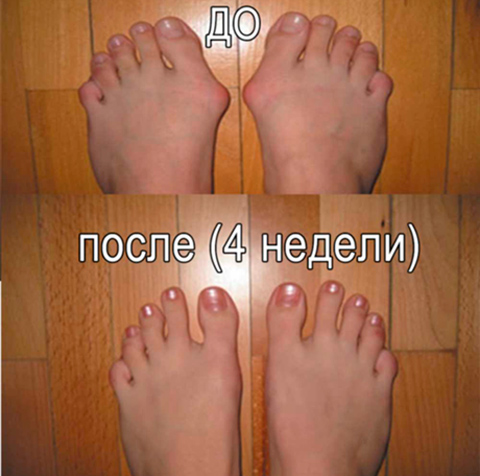 Фиксатор Valgus Pro отзывы, средство от косточки на ноге Valgus Pro отзывы